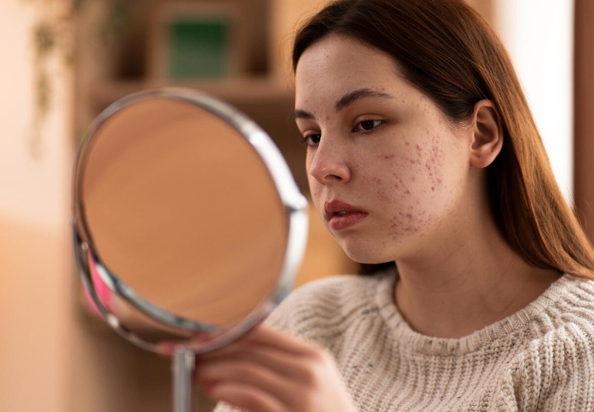 Say Goodbye to Acne with These 4 Proven Remedies